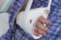Уникальная операция по восстановлению руки прошла в саратовской больнице